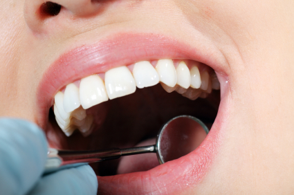 Dental Sealants in New York, NY: Facts and Protection