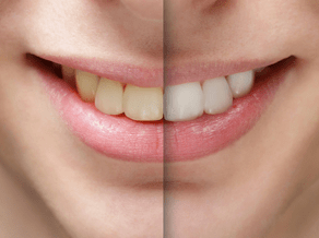 Teeth Whitening Services at West SoHo Dentistry