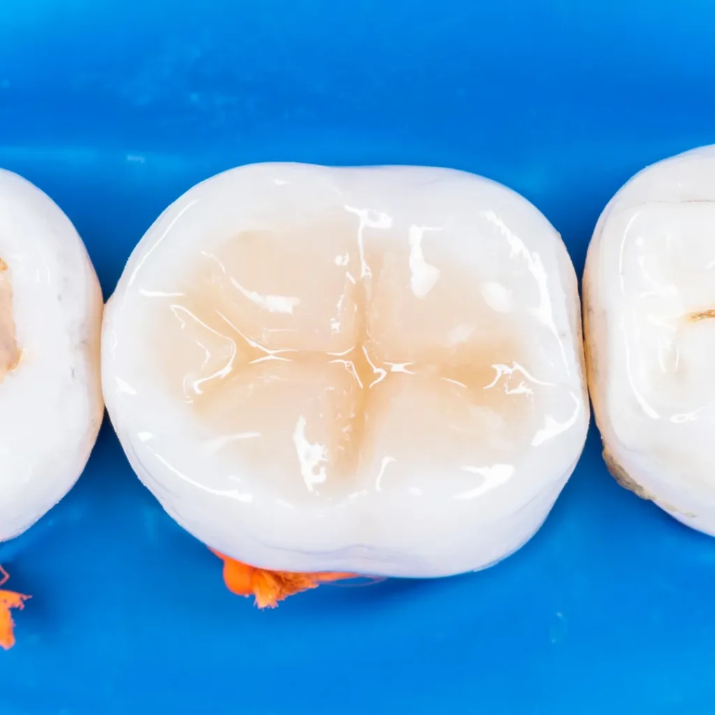 Benefits of Composite Tooth-Colored Fillings