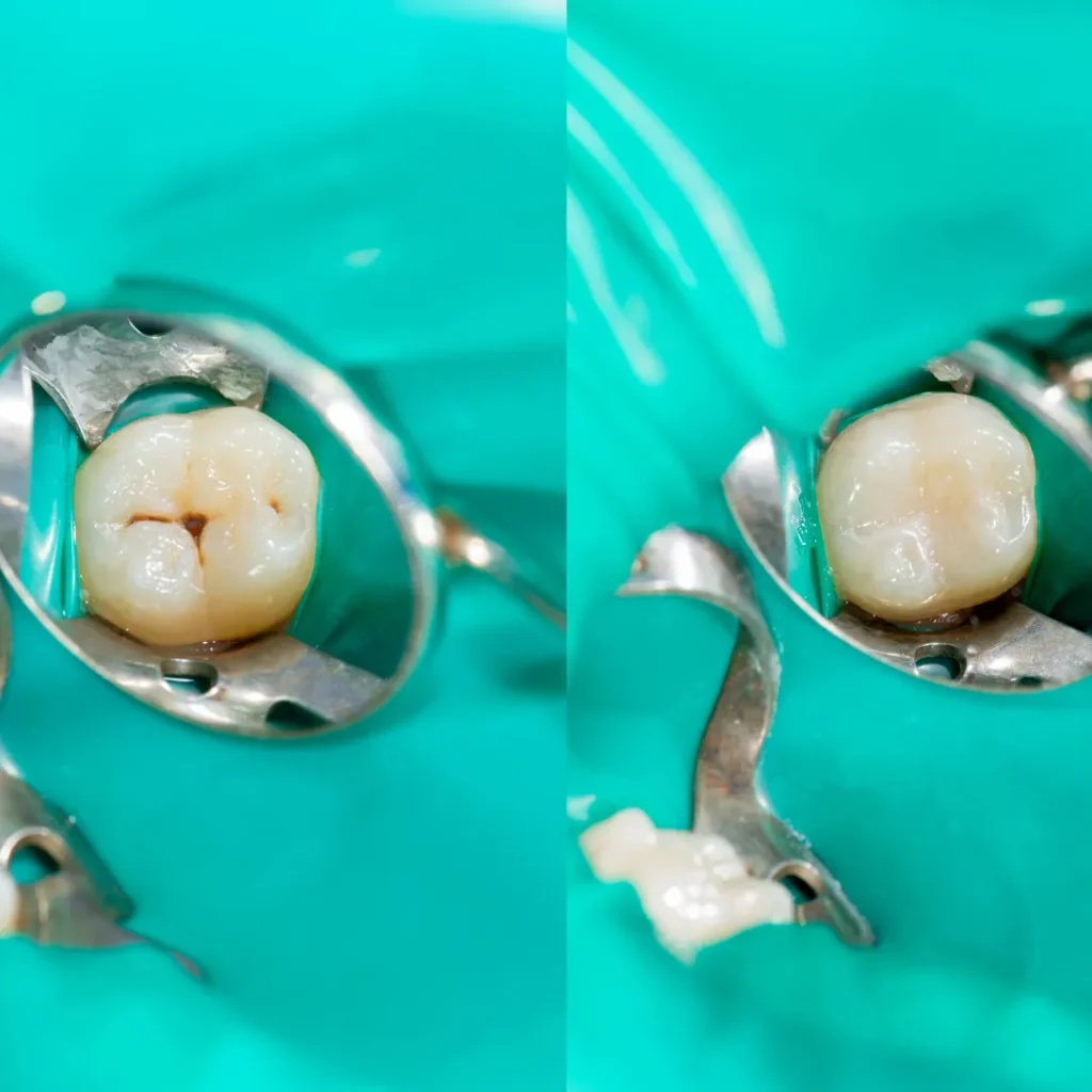 Comparing Filling Materials
