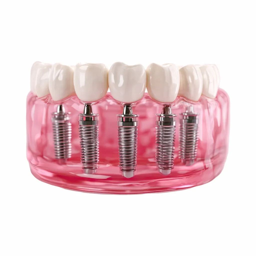 Full Mouth or Full Arch Dental Implants