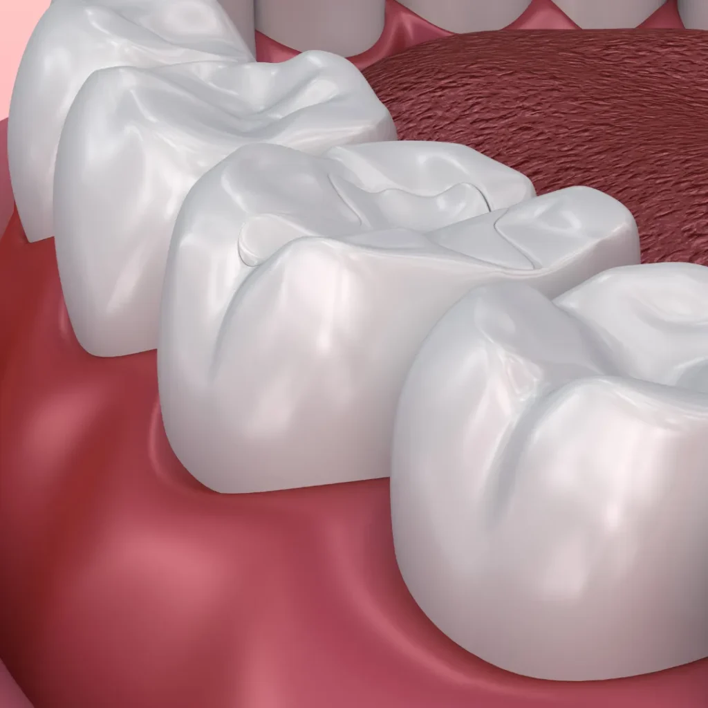 How Long Do Dental Sealants Last