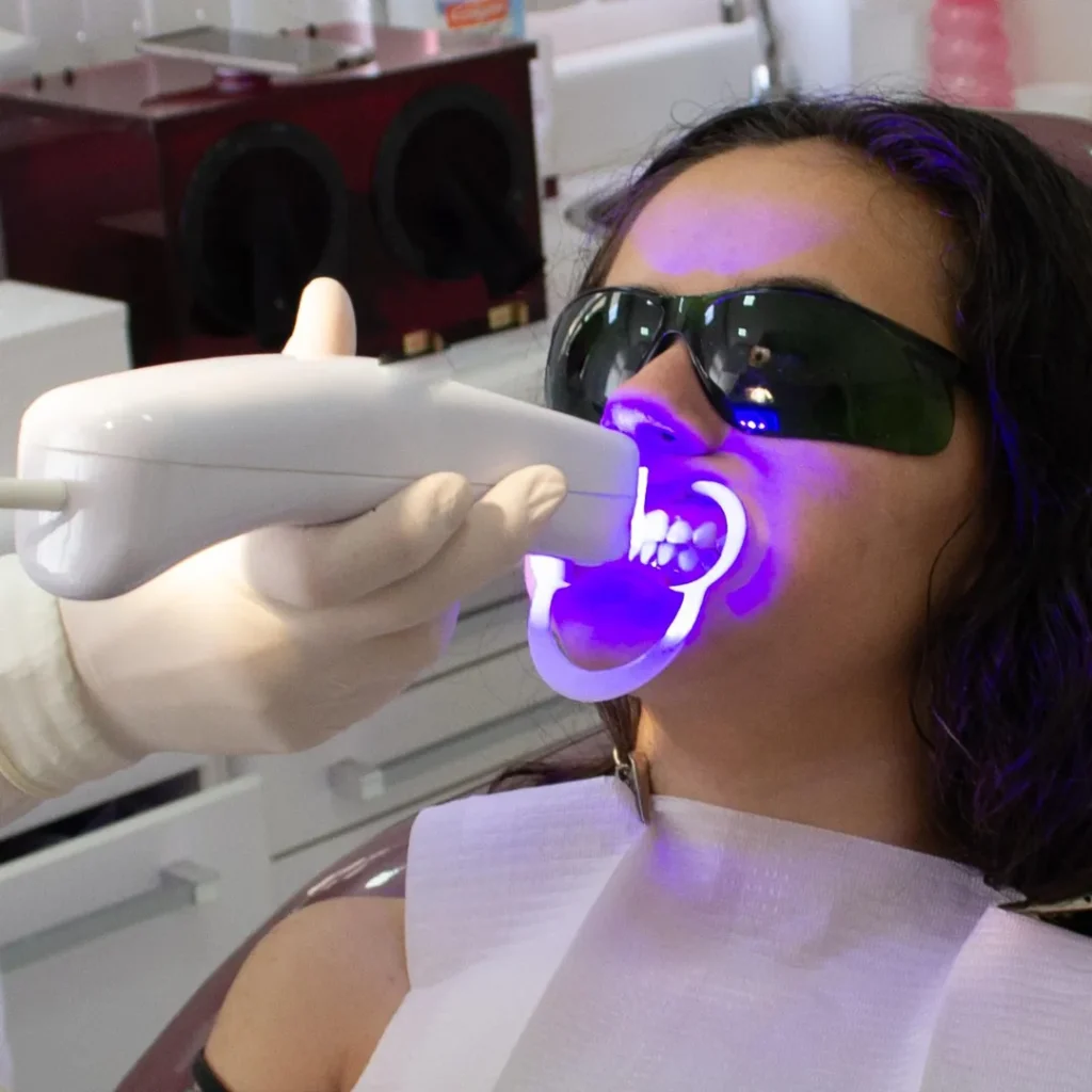 In Office Professional Whitening