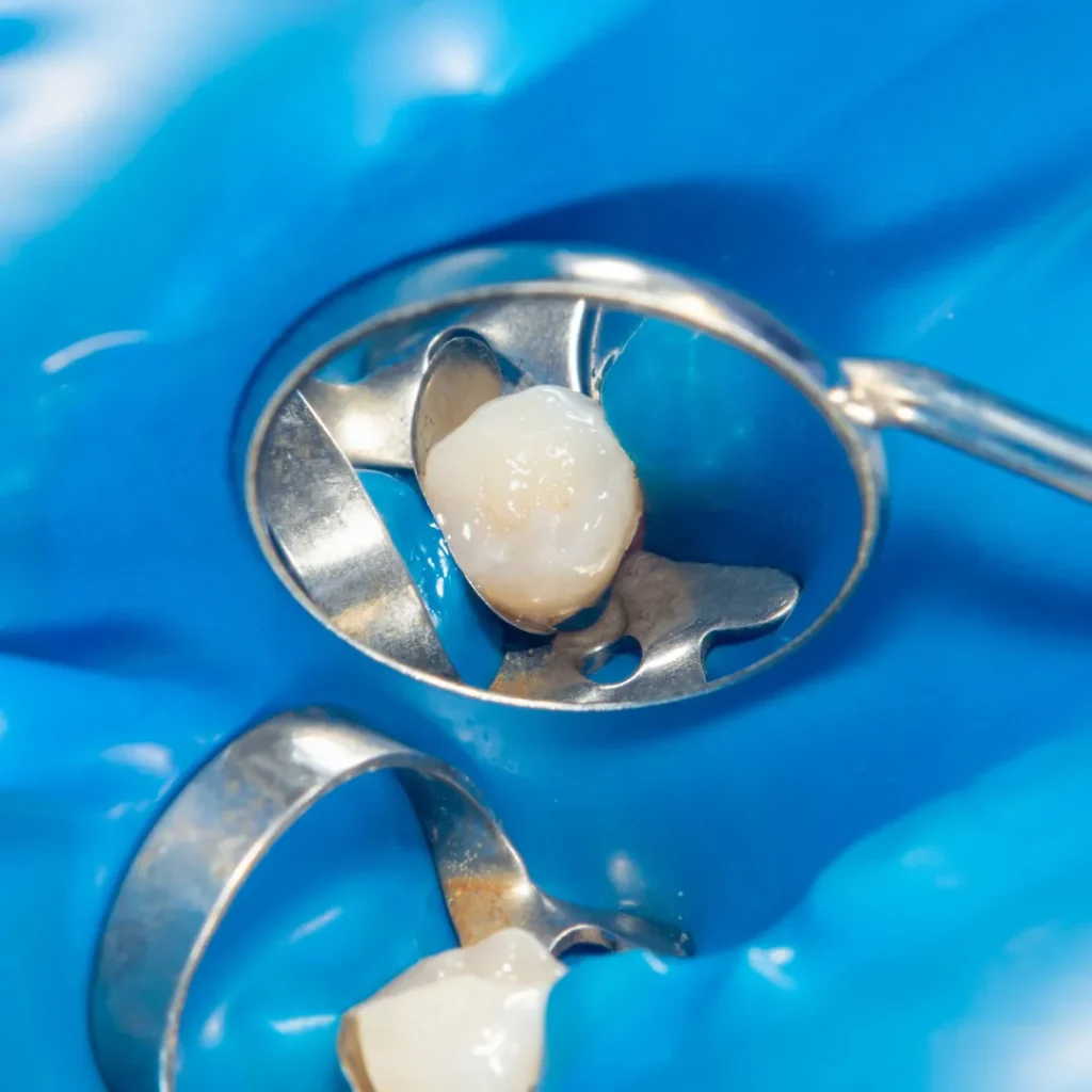 Our Tooth-Colored Filling Process