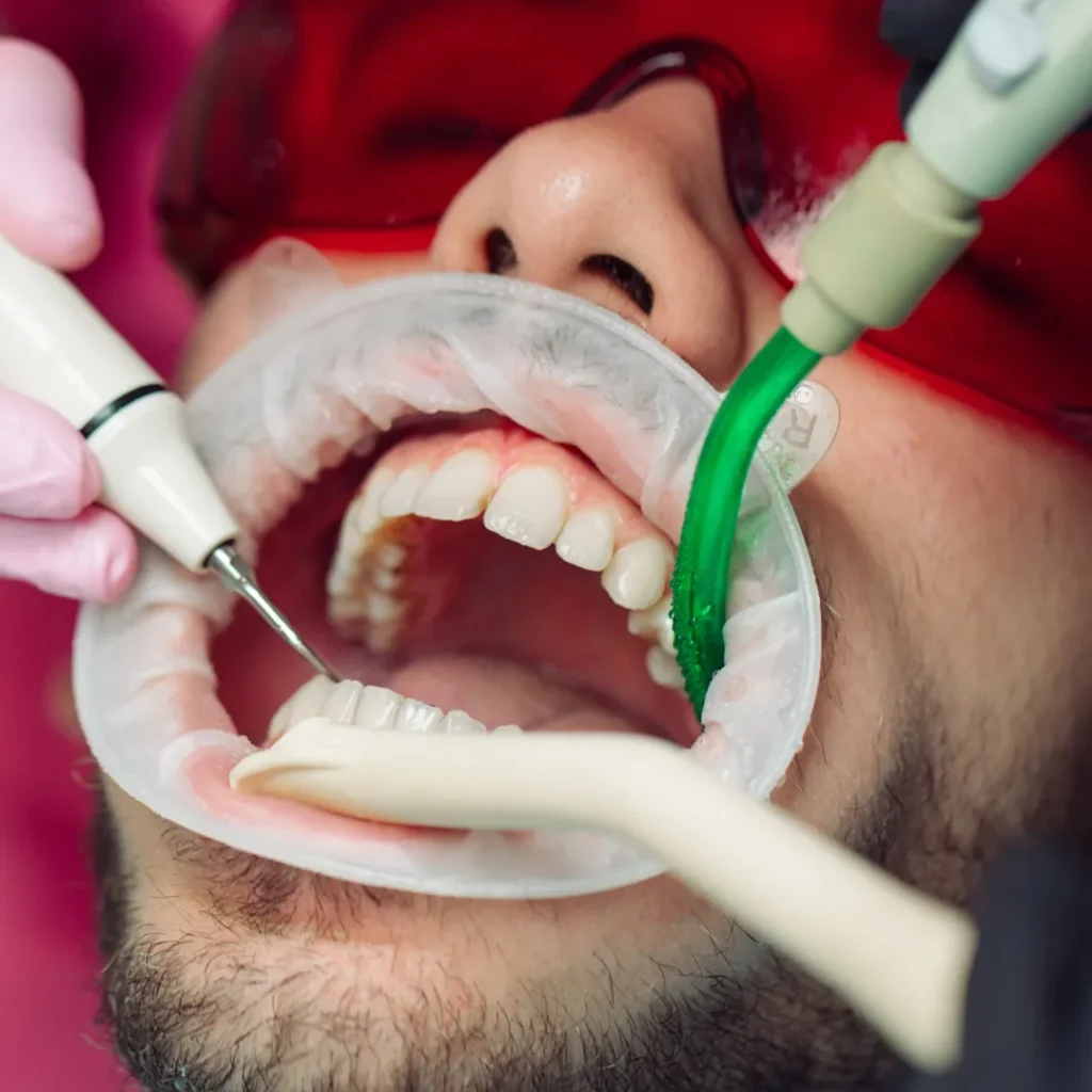 Routine Teeth Cleaning
