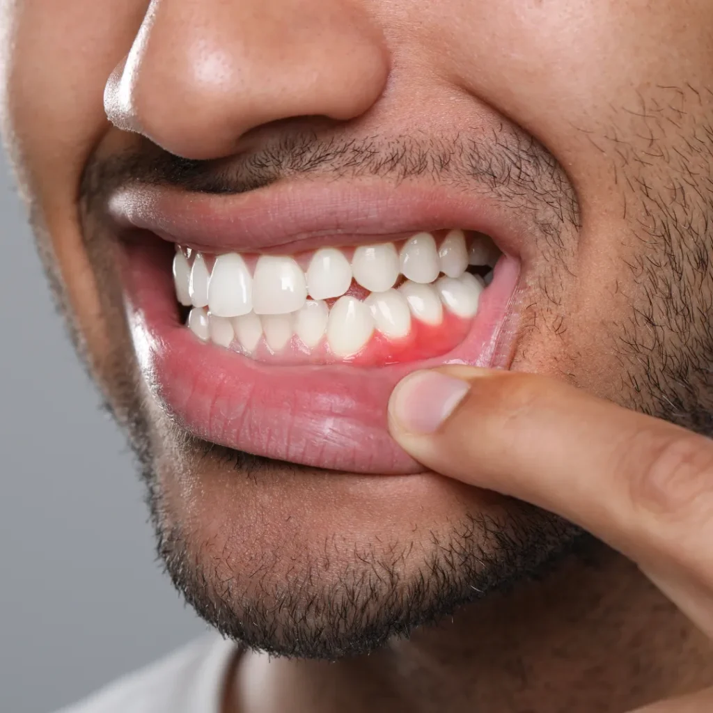 Signs You May Need Gum Disease Treatment