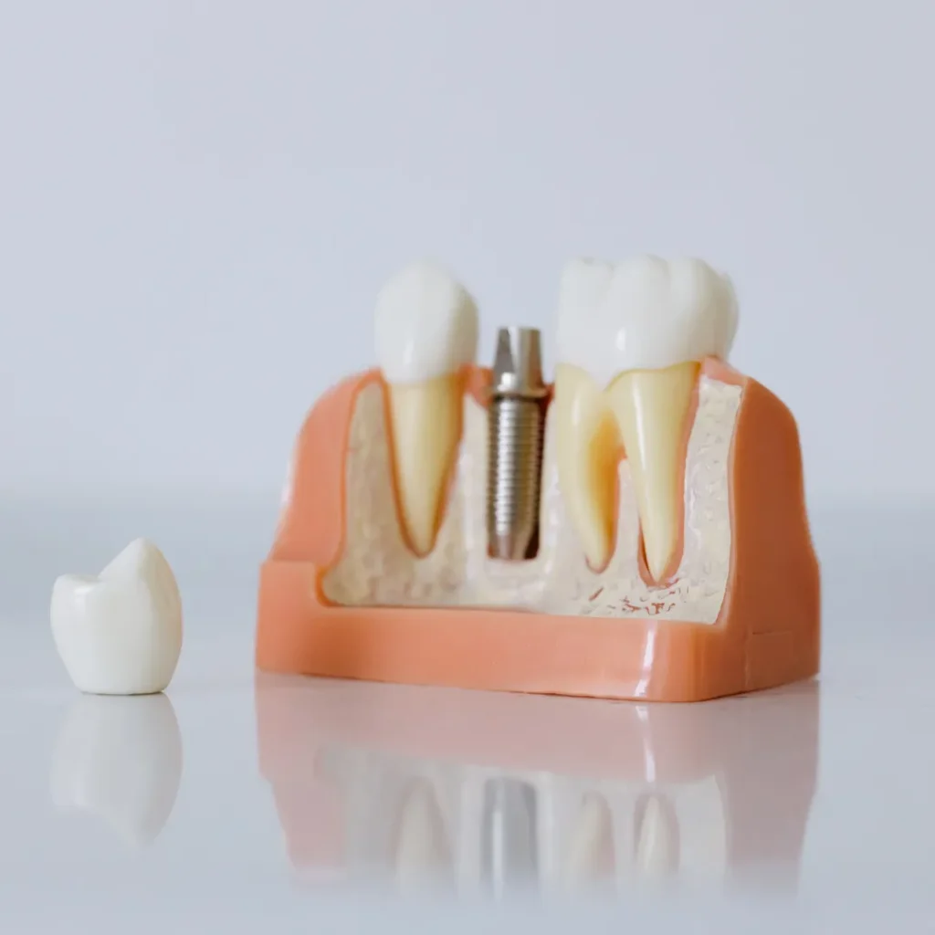 Single Tooth Implants