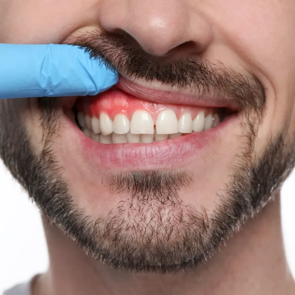 Understanding Gum Disease