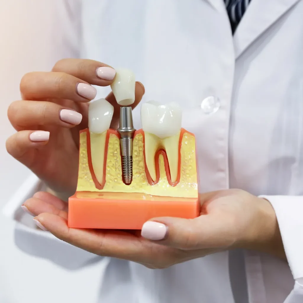 Understanding the Dental Implant Process