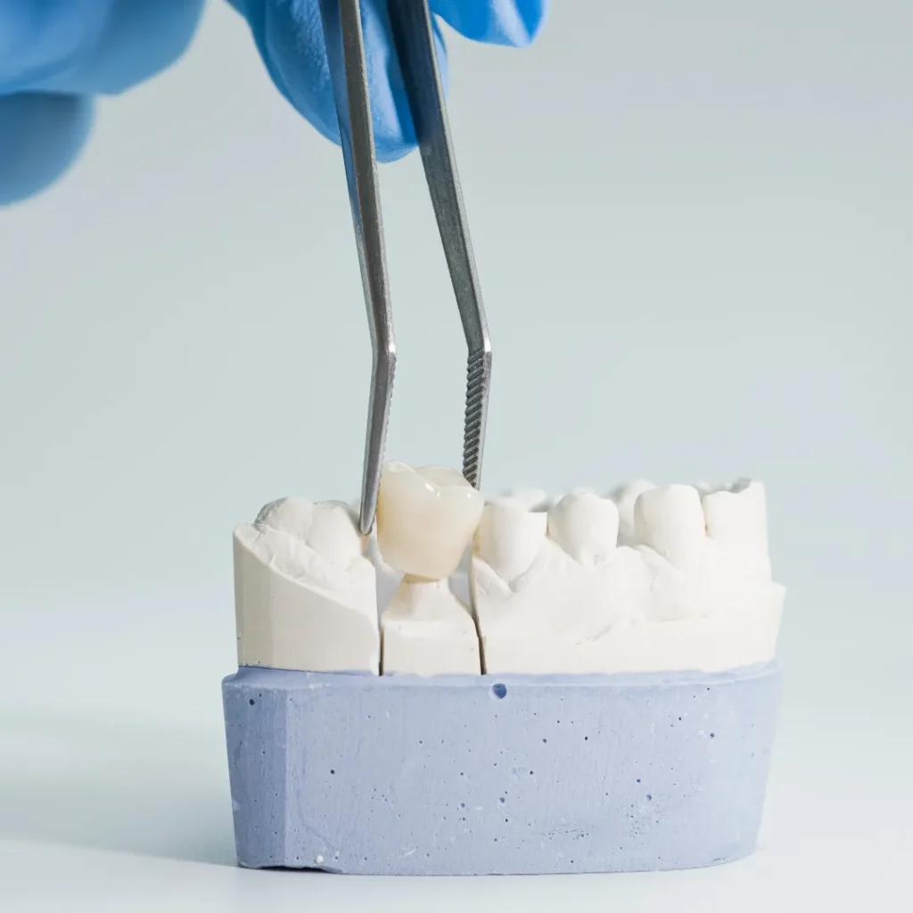 What Are Same Day Dental Crowns