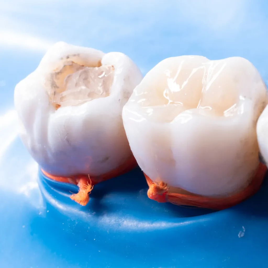 What Are Tooth-Colored Fillings