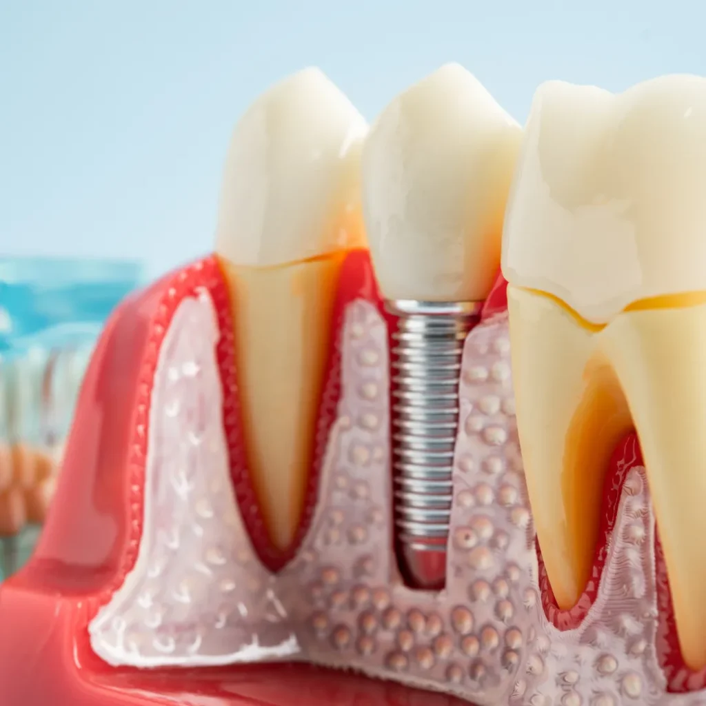 What Is a Dental Implant
