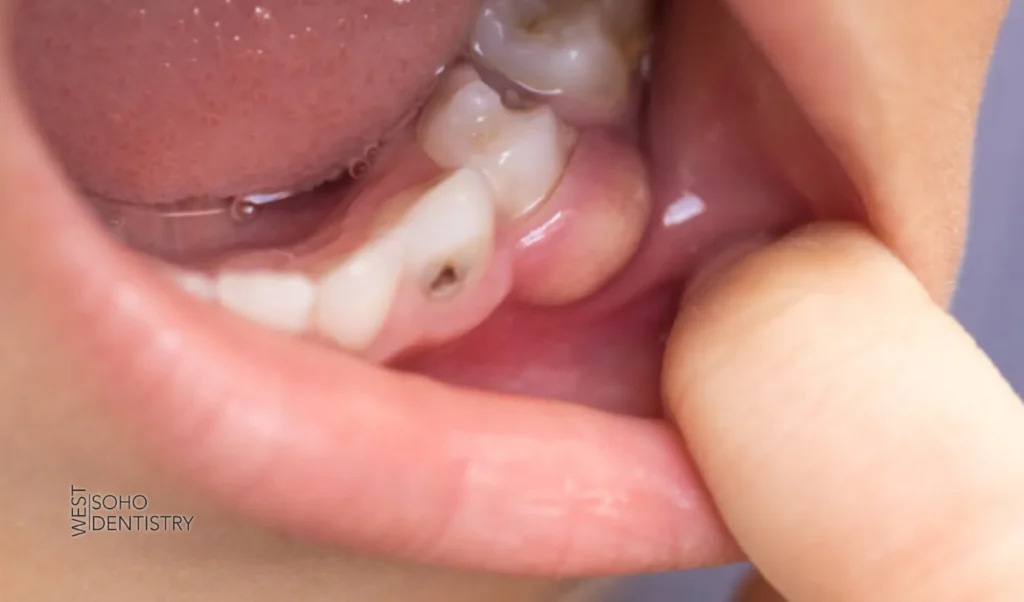 Abscess Tooth Pain