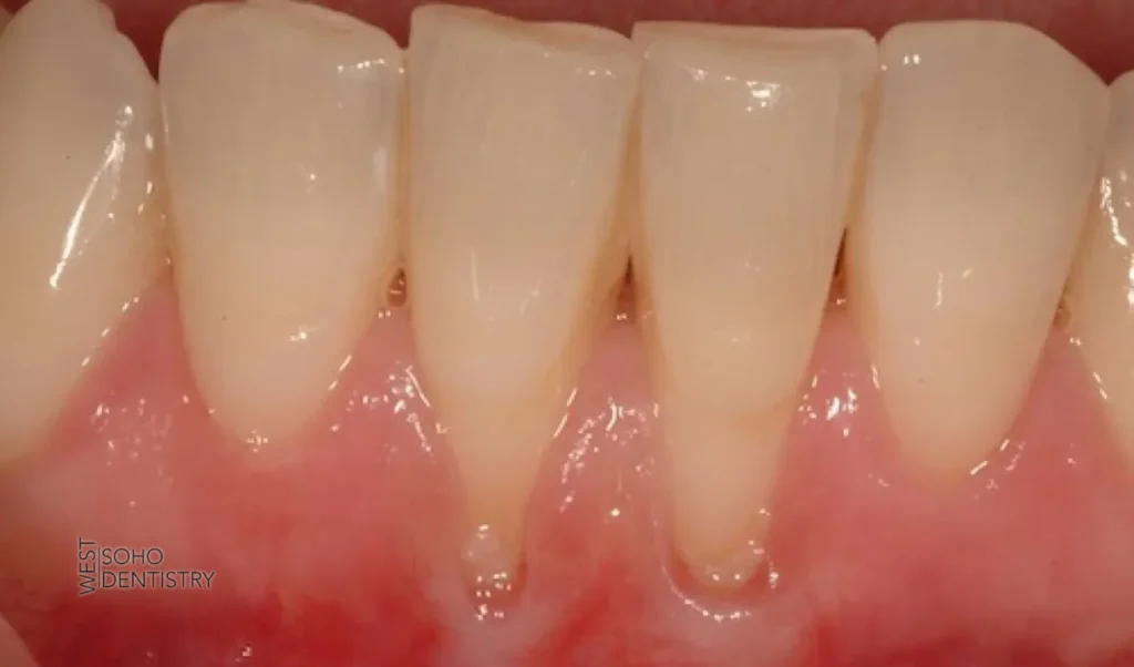 Gum Disease and Tooth Pain