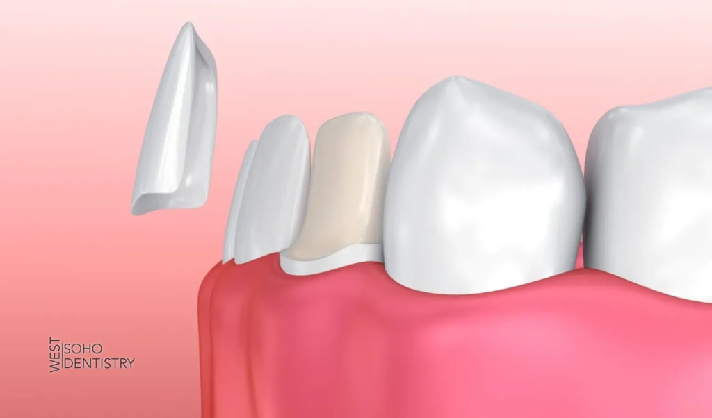 Dental Veneers