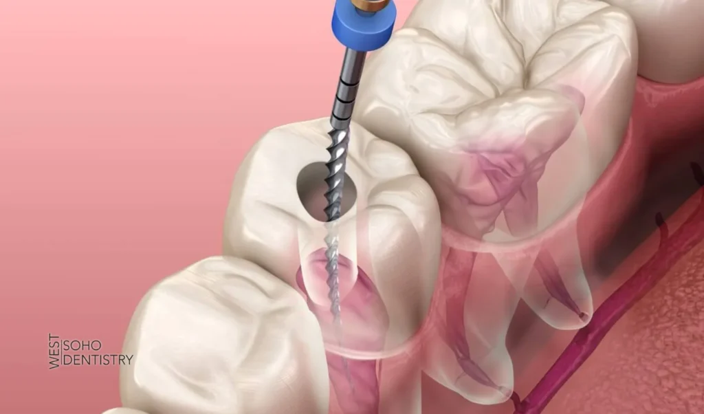 Root Canal Therapy