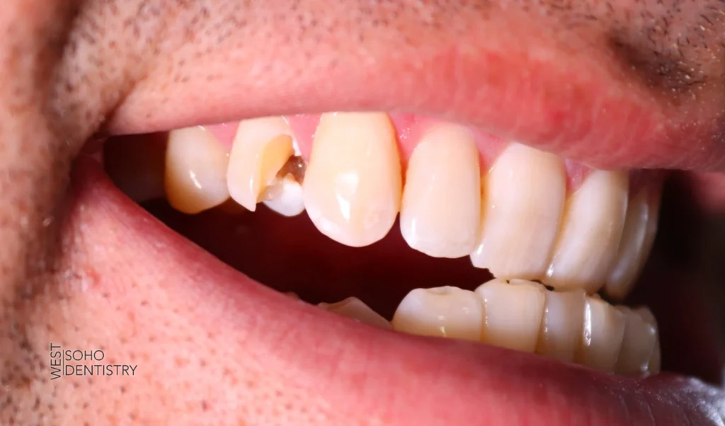 How Minor Chips and Cracks Affect Your Teeth