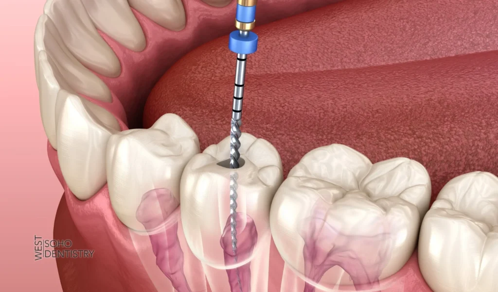 Type of Procedure